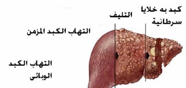 بحث عن فيروس سي جاهز للطباعة